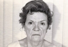 facelift1e