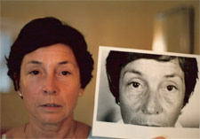 facelift2a
