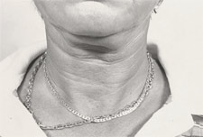 facelift2b