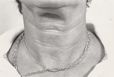 neck_before2r